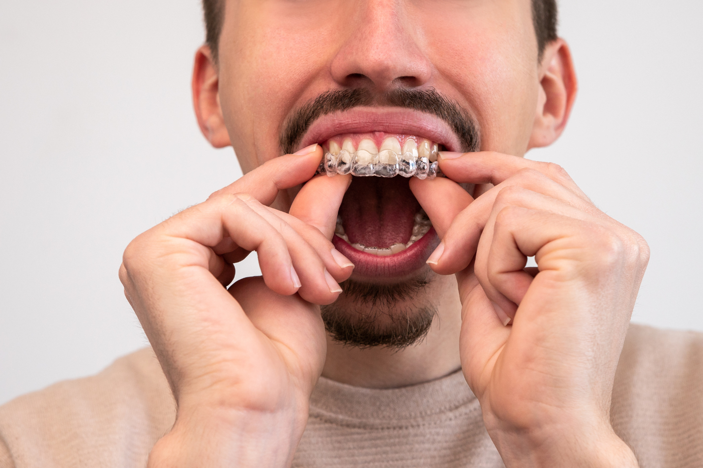 Smile Progress Tracking: How to Know If Your Aligners Are Working